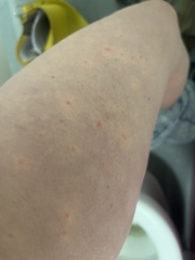 Rash- any ideas? 