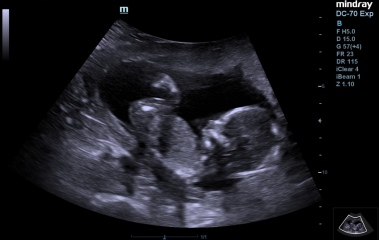 Boy or girl? 