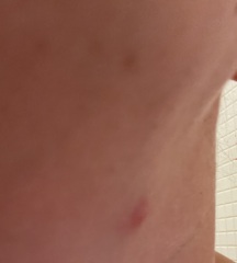 Lump under jaw