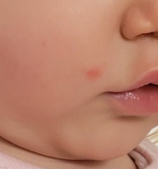 Is this impetigo?