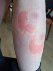 What has bitten me? Sore and itchy.