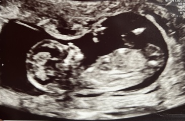Any gender guesses? 12 week scan :)