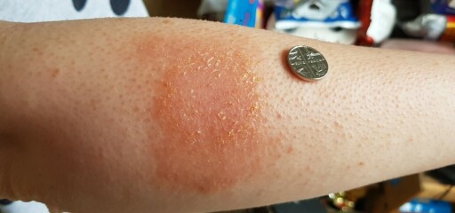 What is this rash?
