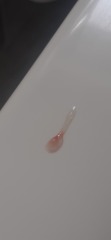Subchorionic hemorrhage, implantation or misscarriage? (content warning: contains graphic images)