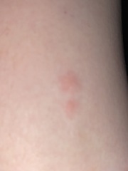 What’s these painful spots on my partners legs?