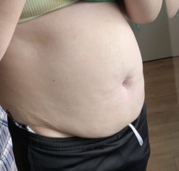 diastasis recti yes or no?