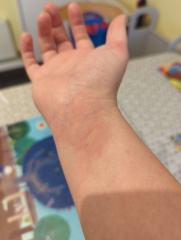 8 weeks - hives!! (pics) 