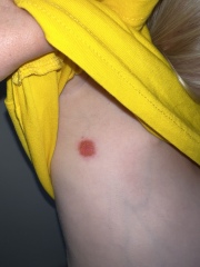 Blisters??