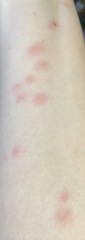What’s these painful spots on my partners legs?