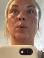 Suddenly greasy face with tiny whiteheads 