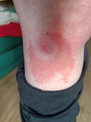 What has bitten me? Sore and itchy.