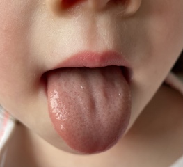 Is this a strawberry tongue?