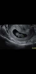 Pregnant after miscarriage - support thread NEW