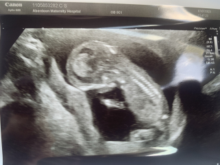 Pregnant after miscarriage - support thread NEW