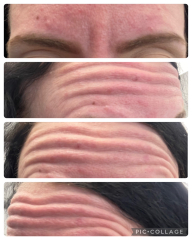 Botox before and after
