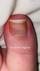 Bizarre big toe nail
