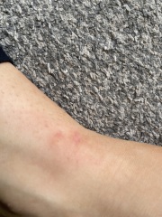 Help what bites are these 