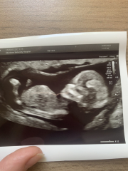 Pregnant after miscarriage - support thread NEW