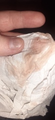 Subchorionic hemorrhage, implantation or misscarriage? (content warning: contains graphic images)