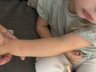 Spots on 2yo’s arm and legs