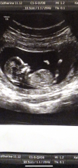 Nub theory! Ultrasound at 12w5d but measuring 13w2d!