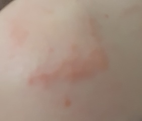 Elbow rash (pics)