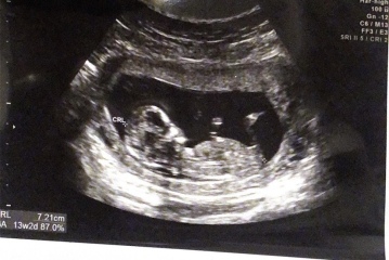 Nub theory! Ultrasound at 12w5d but measuring 13w2d!