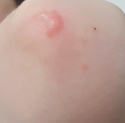 Elbow rash (pics)