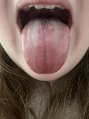 Does this look like thrush? (Tongue pic)