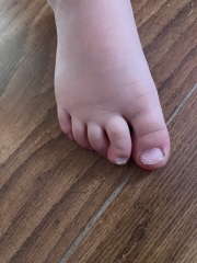 Should I be worried about daughters toes?