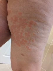 8 weeks - hives!! (pics) 