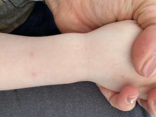 Petechial rash ?