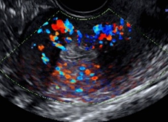 Sudden uterine polyp