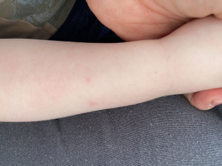 Petechial rash ?