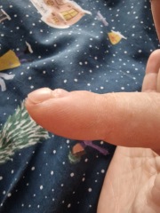 I am going to lose my nail?