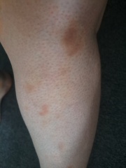 Bruising - Anyone else? Advice?