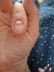 I am going to lose my nail?