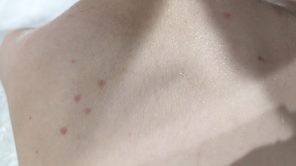 Rash or bug bites? (Pic attached)