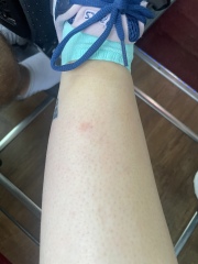 Insect bite when 29 weeks pregnant on holidays in Italy, from UK