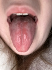Does this look like thrush? (Tongue pic)