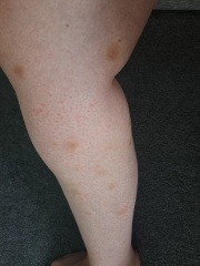 Bruising - Anyone else? Advice?