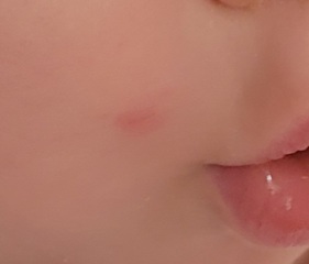 Is this impetigo?