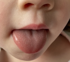 Is this a strawberry tongue?