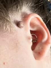 Dark lump on my ear