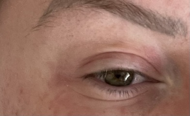 What are these marks on my eyes? *pic*