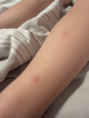 Spots on 2yo’s arm and legs