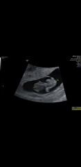 Pregnant after miscarriage - support thread NEW