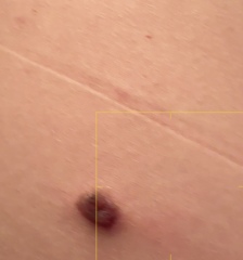 Mole changes - when to get checked