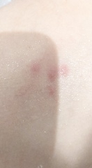 Rash or bug bites? (Pic attached)