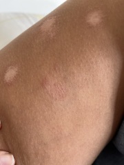 Help please skin patches !!!!